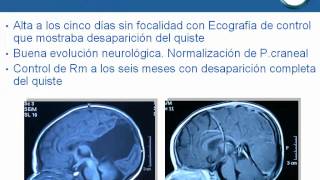 NeurorgsnetQuiste intracerebral en lactante [upl. by Pincince]