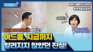 여드름 해방 1부 삼푸 린스 손세정제 몸에 좋다고 함부로 쓰지 말라 [upl. by Anikal44]