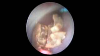 Ureteroscopic LASER stone treatment [upl. by Atinniuq]