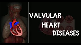 Valvular Heart Disease [upl. by Konstantin]