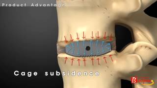 Bioflex Functional Cage SystemBiospine [upl. by Maxia]