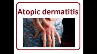 Atopic Dermatitis Symptom  2024 [upl. by Loralie]