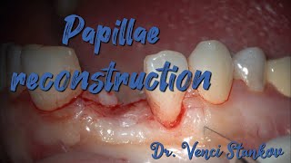 Papillae reconstruction in dental practice Dental surgery operation Dr Venci Stankov [upl. by Schnurr]