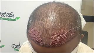 හිසකෙස් බද්ධ කිරීමේ තාක්ෂණය ගැන ඉගෙන ගන්න learn about Sapphire Hair Transplant Technology 0769965660 [upl. by Pat310]