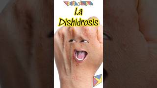 La Dishidrosis 😱 Explicado shortvideo [upl. by Deppy764]