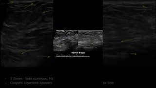 Normal Breast Anatomy Ultrasound  Subcutaneous Retromammary ZonesCooper Ligaments  USG shorts [upl. by Owen]