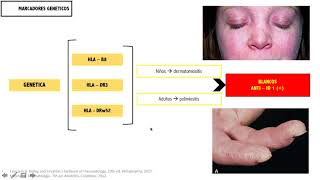 POLIMIOSITIS Y DERMATOMIOSITIS [upl. by Ikir]