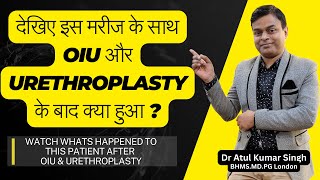 क्या OIU और URETHROPLASTY यूरेथ्रल स्ट्रिक्चर का परमानेंट इलाज है  मरीज की टेस्टिमोनी देखें [upl. by Emearg]