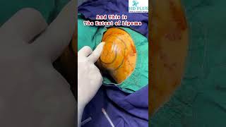 Giant Lipoma Removal With Liposuction Minimal Scar Technique [upl. by Pickens]