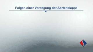 Rekonstruktion und Ersatz der Aortenklappe Teil 2  Erkrankungen der Aortenklappe [upl. by Miquela]