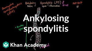 Ankylosing spondylitis  Muscularskeletal diseases  NCLEXRN  Khan Academy [upl. by Orel]