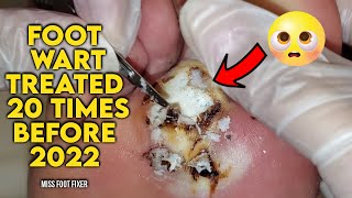 BIGGEST FOOT WART EVER TREATED 20 TIMES BEFORE  BY MISS FOOT FIXER [upl. by Yevreh]