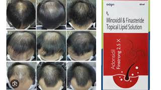 Adonsidil Finstrong 25 X Topical Solution Minoxidil amp Finasteride Topical Lipid Solution [upl. by Llennyl]