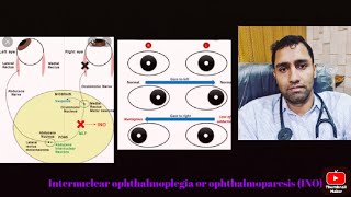 Internuclear ophthalmoplegia INO Neurophysiology and Neuroanatomyophthalmology medicalhindi [upl. by Bilbe]