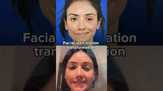 4 months post op facial reanimation surgery facialparalysis drazizzadeh [upl. by Ettenom]