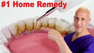 1 Home Remedy to Remove Dental Plaque amp Tarter to Prevent Cavities  Dr Mandell [upl. by Hpesojnhoj53]