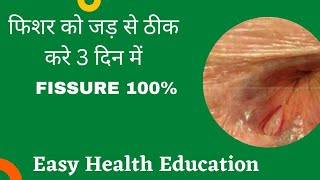 Fissure Treatment in home Hindi  फिशर को घर बैठे कैसे ठीक करे 100 Fissure home remedies [upl. by Olumor]