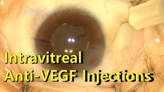 Intravitreal injection technique 유리체강내 아바스틴 주사술 [upl. by Raynor]