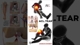 Management and Treatment of ACL Tears in Adults medical animation 3d short Biology with Aliya [upl. by Essilevi]