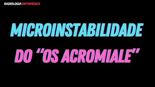 Os Acromiale com microinstabilidade [upl. by Aihsram]