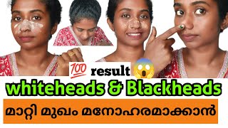 💯Blackheads amp Whiteheads പെട്ടന്ന് മാറ്റി മുഖം മനോഹരമാക്കാൻ ഇങ്ങനെ ചെയ്യൂ💯malayalam youtube [upl. by Ellehcin]