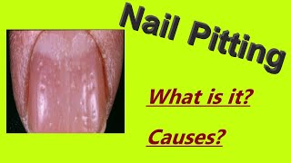 Nail pitting Pitted nails [upl. by Noet]