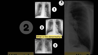 Causes of Bilateral Hilar Lymphadenopathy pulmonology internalmedicine xray [upl. by Berkin]