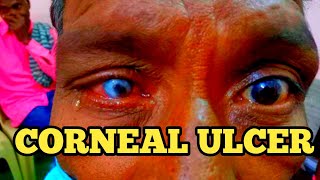 CORNEAL ULCERKeratitisOphthalmology amp OptometryAt tamil [upl. by Uol]