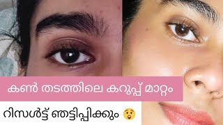 എന്റെ മോളെ permanently remove Under eye dark circlesകറുത്ത കണ്ണ് ഇനി വരില്ല 💯 [upl. by Pacifica]