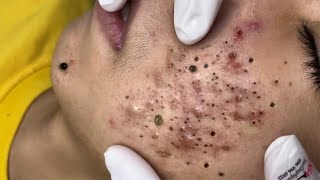 Big Cystic Acne Blackheads Extraction Blackheads amp Milia Whiteheads Removal Pimple Popping  9000 [upl. by Ys225]