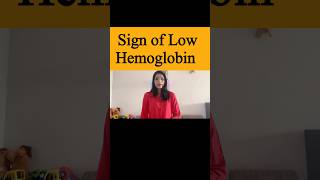 Hemoglobin levels drop sign [upl. by Maddis]