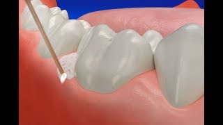 How Gum Disease Treatment Laser works [upl. by Letsyrc]