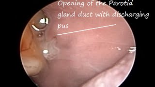 Disorder of Salivary Gland  Pus discharge from parotid duct opening Acute Suppurative Parotitis [upl. by Spalla]