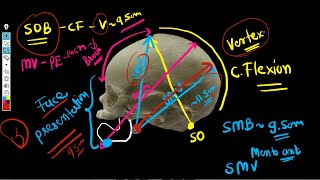 Fetal Skull Diameters  Diameters of engagement [upl. by Doti]