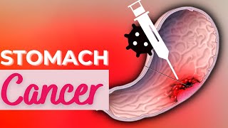 Stomach Cancer Causes Signs and Symptoms Diagnosis and Treatment [upl. by Leirraj]