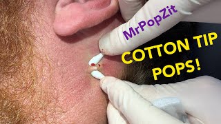 A quick popping session to hold you over Shallow follicular cysts extracted With Bonus blackhead [upl. by Perle]