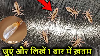 सर की जुएं liceऔर लिखें Nits 1 बार में ख़तम  बालों के लिए  Head Lice amp Nits Removal at home [upl. by Gemma225]