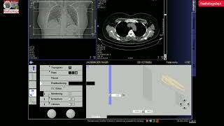 CT Pulmonary Angiography Full Process In Hindi  ctpulmonaryangio Radiologydept [upl. by Schinica]