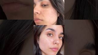 How I Reduced My Pigmentation In 2 weeks😍 [upl. by Aihseya]