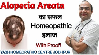 Alopecia Areata treatment  hair loss treatment  baldness best treatment बाल झड़ने का तेल ईलाज [upl. by Araem]