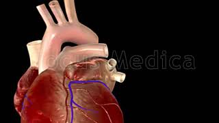 Atrial Fibrillation Triggers  Animated Atlas of Atrial Fibrillation [upl. by Tedi]