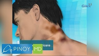 Pinoy MD Pangingitim ng batok ay sintomas ba ng diabetes [upl. by Anaidirib]