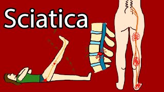 Sciatica  Onesided Leg pain and tingling Sciatica Symptoms and Treatment Radiculopathy [upl. by Ahseken765]