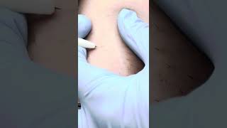 Relaxing electrolysis hair removal Zap hairs with me [upl. by Eelydnarb]