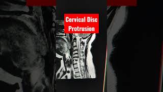 Cervical Foraminal Disc Protrusion of C56 level [upl. by Rudin]