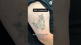 Before amp After Tattoo Removal [upl. by Yeneffit]