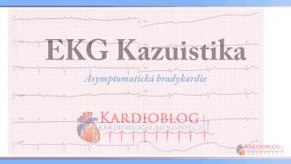 Kardioblog  EKG Kazuistika Asymptomatická bradykardie [upl. by Barbey673]