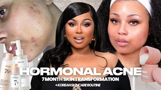 How I Transformed My Hormonal Acne in Just 7 Months  Real Results  Tips That Actually Work [upl. by Eidoc]