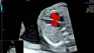 Single Muscular Ventricular Septal Defect  Fetal ECHO [upl. by Lednyc]