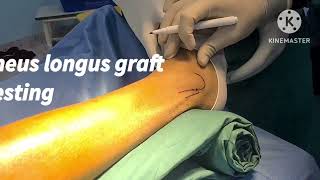 Peroneus Longus tendon graft harvesting [upl. by Siffre]